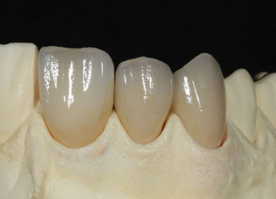 Importance Of Zirconia Crown For Your Teeth